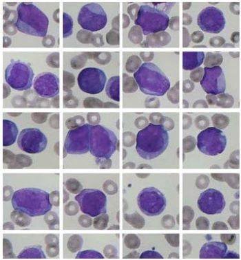 A slide showing abnormal blood cells